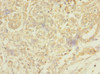 Immunohistochemistry of paraffin-embedded human pancreatic cancer using CSB-PA871559ESR2HU at dilution of 1:100
