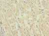 Immunohistochemistry of paraffin-embedded human gastric cancer using CSB-PA614400ESR2HU at dilution of 1:100