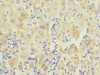 Immunohistochemistry of paraffin-embedded human liver cancer using CSB-PA019044ESR1HU at dilution of 1:100