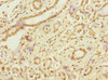 Immunohistochemistry of paraffin-embedded human pancreatic cancer using CSB-PA867162DSR1HU at dilution of 1:100