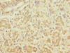 Immunohistochemistry of paraffin-embedded human pancreatic cancer using CSB-PA867162DSR2HU at dilution of 1:100
