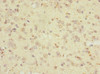 Immunohistochemistry of paraffin-embedded human glioma using CSB-PA019662ESR1HU at dilution of 1:100