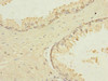Immunohistochemistry of paraffin-embedded human prostate cancer using CSB-PA819465ESR2HU at dilution of 1:100