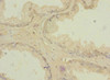 Immunohistochemistry of paraffin-embedded human prostate cancer using CSB-PA026486ESR1HU at dilution of 1:100