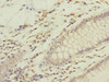 Immunohistochemistry of paraffin-embedded human colon cancer using CSB-PA856889ESR1HU at dilution of 1:100