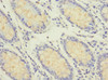 Immunohistochemistry of paraffin-embedded human colon cancer using CSB-PA856889ESR2HU at dilution of 1:100