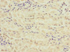 Immunohistochemistry of paraffin-embedded human gastric cancer using CSB-PA020104ESR1HU at dilution of 1:100