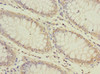 Immunohistochemistry of paraffin-embedded human colon cancer using CSB-PA002390ESR1HU at dilution of 1:100
