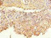 Immunohistochemistry of paraffin-embedded human cervical cancer using CSB-PA891968DSR2HU at dilution of 1:100