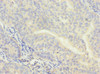 Immunohistochemistry of paraffin-embedded human endometrial cancer using CSB-PA005919ESR1HU at dilution of 1:100