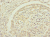 Immunohistochemistry of paraffin-embedded human pancreatic cancer using CSB-PA007399ESR1HU at dilution of 1:100
