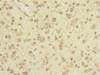 Immunohistochemistry of paraffin-embedded human glioma using CSB-PA852881ESR1HU at dilution of 1:100