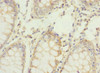 Immunohistochemistry of paraffin-embedded human colon cancer using CSB-PA019535ESR1HU at dilution of 1:100