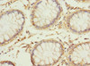 Immunohistochemistry of paraffin-embedded human colon cancer using CSB-PA019535ESR2HU at dilution of 1:100