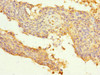 Immunohistochemistry of paraffin-embedded human cervical cancer using CSB-PA362460ESR2HU at dilution of 1:100