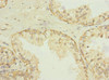 Immunohistochemistry of paraffin-embedded human prostate cancer using CSB-PA022646ESR2HU at dilution of 1:100