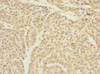 Immunohistochemistry of paraffin-embedded human ovarian cancer using CSB-PA023553ESR2HU at dilution of 1:100