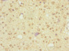 Immunohistochemistry of paraffin-embedded human glioma using CSB-PA875730ESR1HU at dilution of 1:100