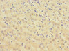 Immunohistochemistry of paraffin-embedded human liver cancer using CSB-PA615684ESR2HU at dilution of 1:100