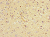 Immunohistochemistry of paraffin-embedded human glioma using CSB-PA887022ESR1HU at dilution of 1:100