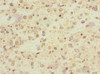 Immunohistochemistry of paraffin-embedded human glioma using CSB-PA887022ESR2HU at dilution of 1:100