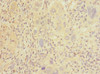 Immunohistochemistry of paraffin-embedded human liver cancer using CSB-PA885789ESR1HU at dilution of 1:100