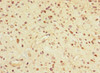 Immunohistochemistry of paraffin-embedded human glioma using CSB-PA009144ESR1HU at dilution of 1:100