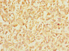 Immunohistochemistry of paraffin-embedded human melanoma using CSB-PA011874ESR1HU at dilution of 1:100