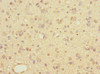 Immunohistochemistry of paraffin-embedded human glioma using CSB-PA839321ESR2HU at dilution of 1:100