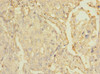 Immunohistochemistry of paraffin-embedded human lung cancer using CSB-PA880072ESR2HU at dilution of 1:100