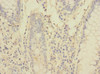 Immunohistochemistry of paraffin-embedded human colon cancer using CSB-PA2106ESR2HU at dilution of 1:100