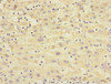Immunohistochemistry of paraffin-embedded human liver cancer using CSB-PA873646DSR1HU at dilution of 1:100