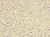 Immunohistochemistry of paraffin-embedded human liver cancer using CSB-PA873646DSR2HU at dilution of 1:100