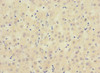 Immunohistochemistry of paraffin-embedded human liver cancer using CSB-PA743558ESR1HU at dilution of 1:100