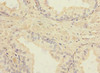 Immunohistochemistry of paraffin-embedded human prostate cancer using CSB-PA025162ESR1HU at dilution of 1:100