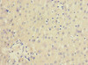 Immunohistochemistry of paraffin-embedded human liver cancer using CSB-PA887035ESR1HU at dilution of 1:100