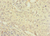 Immunohistochemistry of paraffin-embedded human lung cancer using CSB-PA853454ESR1HU at dilution of 1:100