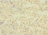 Immunohistochemistry of paraffin-embedded human gastric cancer using CSB-PA853454ESR1HU at dilution of 1:100