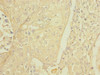 Immunohistochemistry of paraffin-embedded human lung cancer using CSB-PA853454ESR2HU at dilution of 1:100