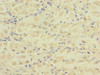 Immunohistochemistry of paraffin-embedded human gastric cancer using CSB-PA853454ESR2HU at dilution of 1:100