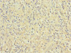 Immunohistochemistry of paraffin-embedded human lung cancer using CSB-PA011879ESR1HU at dilution of 1:100