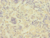 Immunohistochemistry of paraffin-embedded human liver cancer using CSB-PA011891ESR1HU at dilution of 1:100