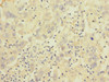 Immunohistochemistry of paraffin-embedded human liver cancer using CSB-PA011891ESR2HU at dilution of 1:100