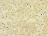Immunohistochemistry of paraffin-embedded human gastric cancer using CSB-PA018824ESR2HU at dilution of 1:100