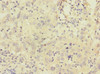 Immunohistochemistry of paraffin-embedded human liver cancer using CSB-PA004439ESR1HU at dilution of 1:100