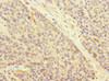 Immunohistochemistry of paraffin-embedded human ovarian cancer using CSB-PA002435ESR1HU at dilution of 1:100