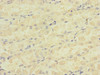 Immunohistochemistry of paraffin-embedded human gastric cancer using CSB-PA002435ESR1HU at dilution of 1:100