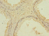 Immunohistochemistry of paraffin-embedded human prostate cancer using CSB-PA745871ESR1HU at dilution of 1:100