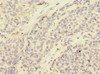 Immunohistochemistry of paraffin-embedded human ovarian cancer using CSB-PA745871ESR2HU at dilution of 1:100