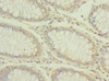 Immunohistochemistry of paraffin-embedded human colon cancer using CSB-PA2107ESR1HU at dilution of 1:100